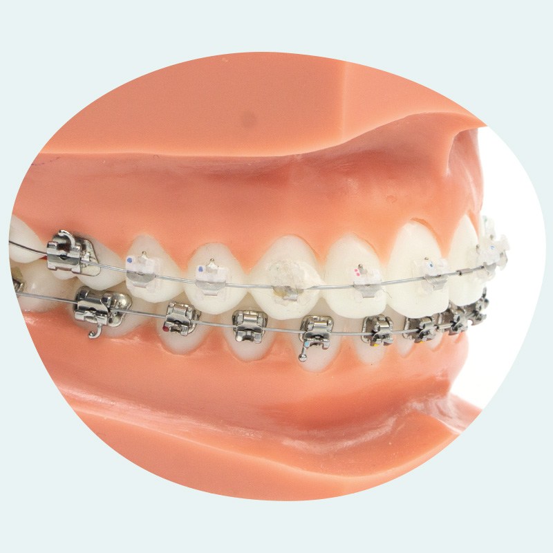 exemple d'appareil orthodontique